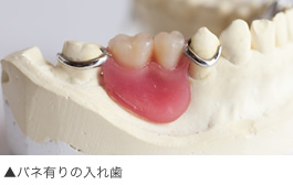 バネ有りの入れ歯