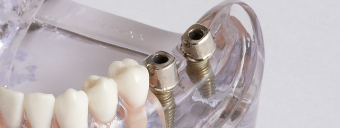 インプラントイメージ