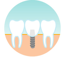 インプラントイメージ