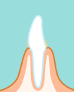 歯肉炎イメージ