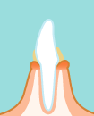 軽度歯周炎イメージ