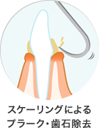 スケーリングによる プラーク・歯石除去
