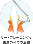 ルートプレーニングや歯周外科での治療