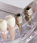 歯を抜かずに済む方法イメージ